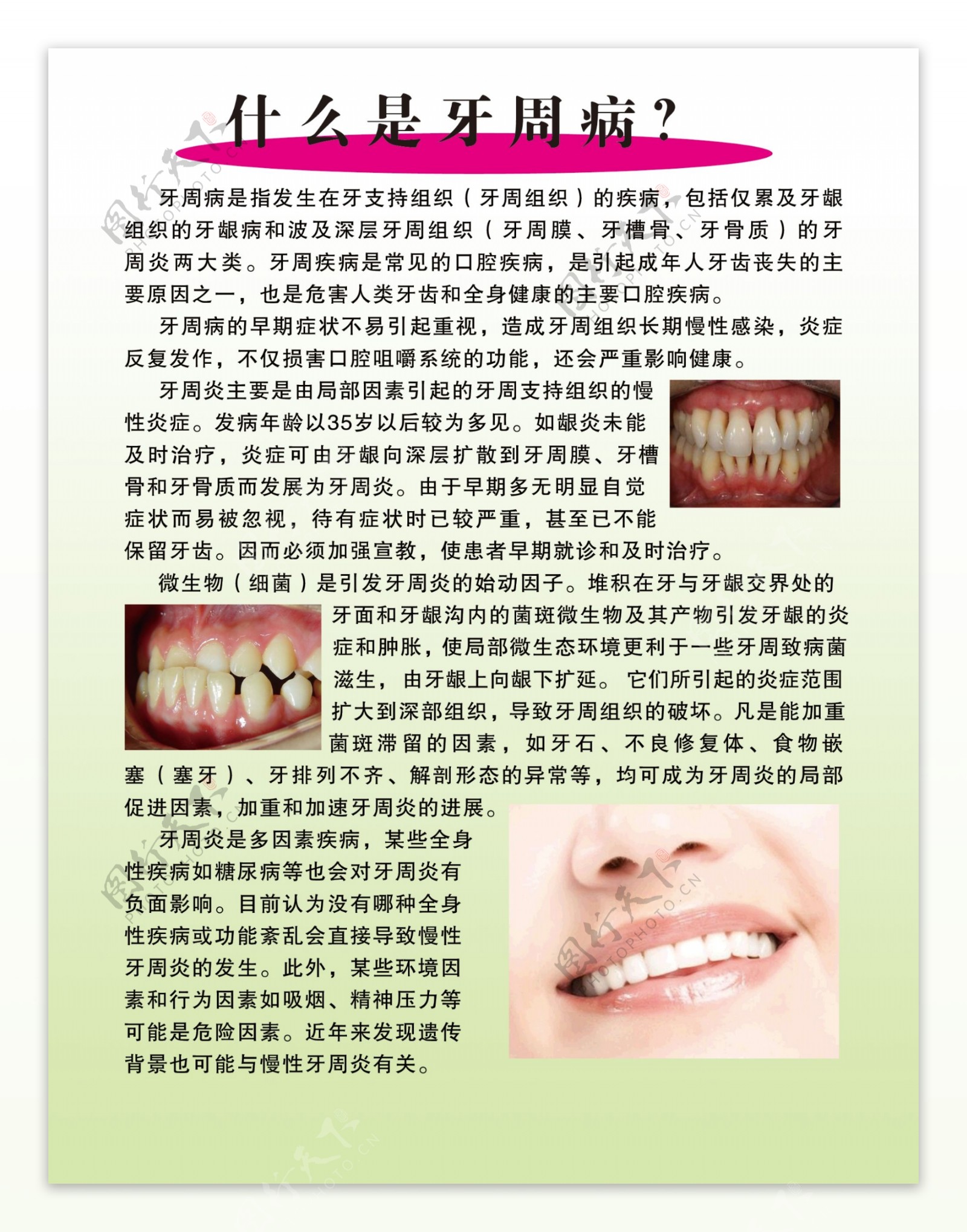 病媒医学插图的现实健康牙齿和牙周炎疾病插画图片素材_ID:322712625-Veer图库