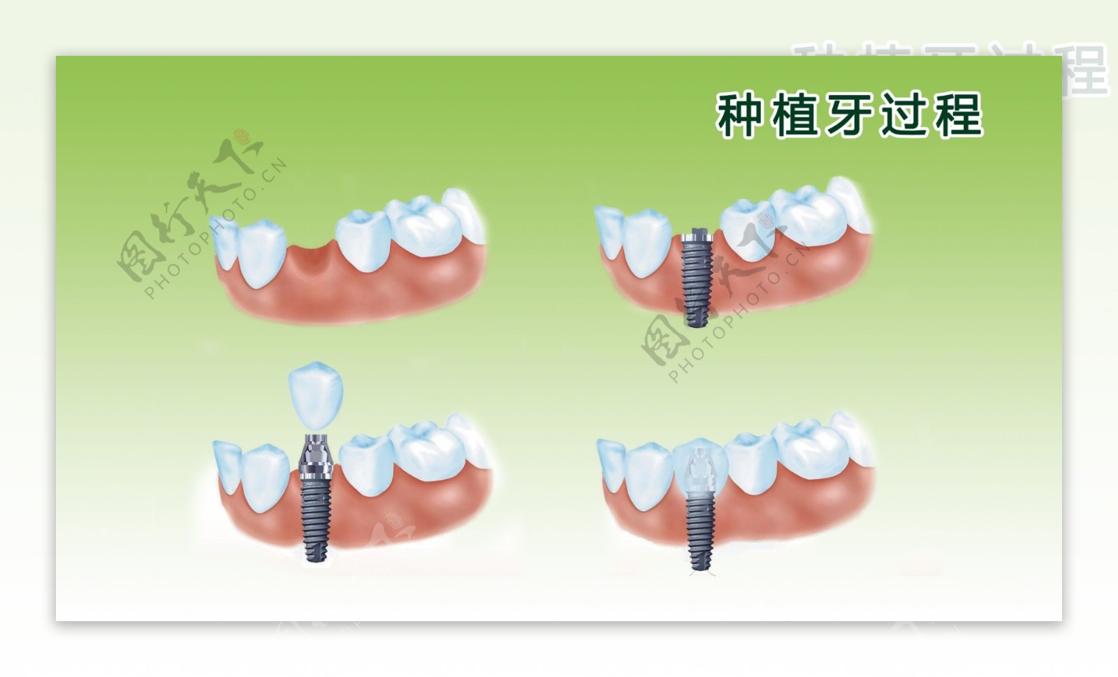 广州种植牙：种牙？完整流程图展示一下！ - 知乎