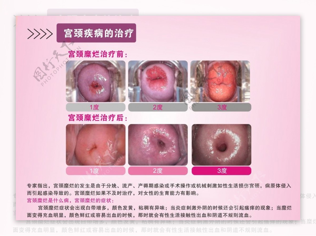 宫颈疾病治疗图片