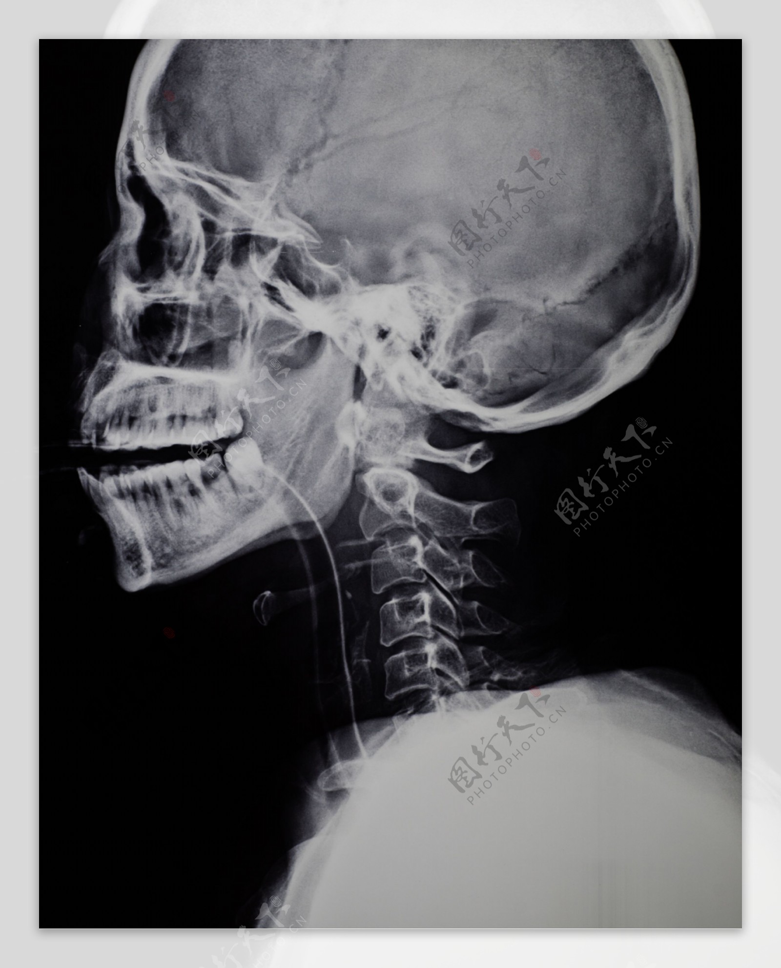 脖子X光片图片