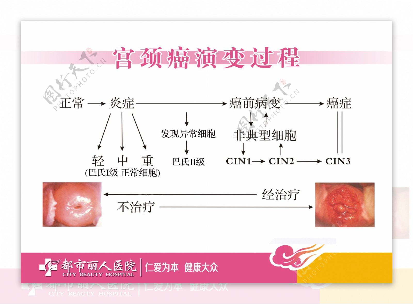 宫颈癌变过程巴氏分级