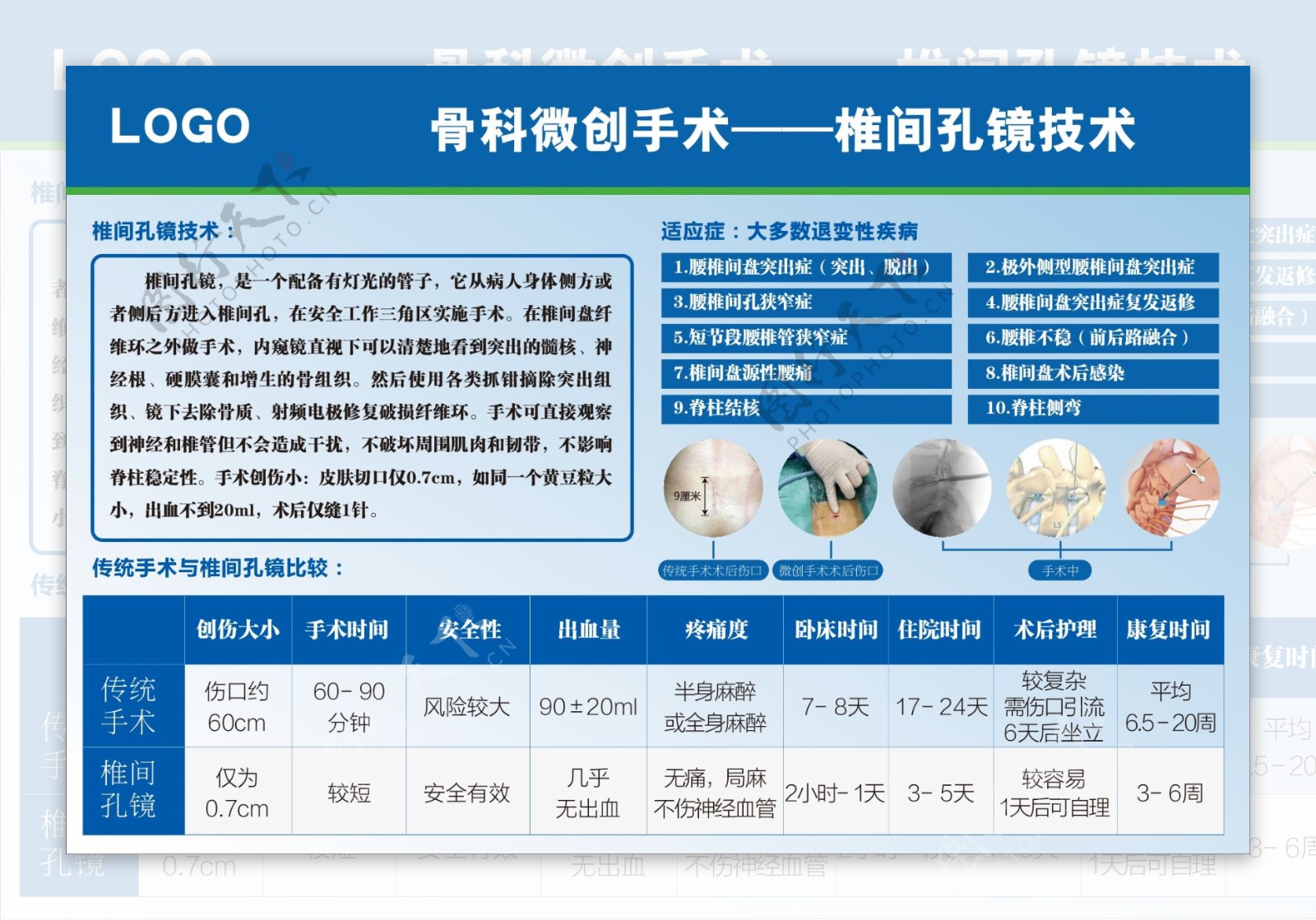 椎间孔镜技术